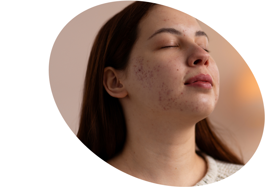 Acne Skincare - Shop Serums &amp; Creams for Acne &amp; Pimples Malaysia