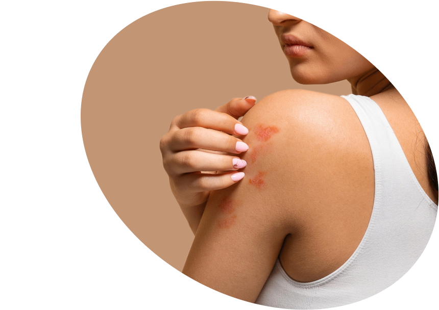 Psoriasis on the Body - Shop Soothing Body Care Products Malaysia