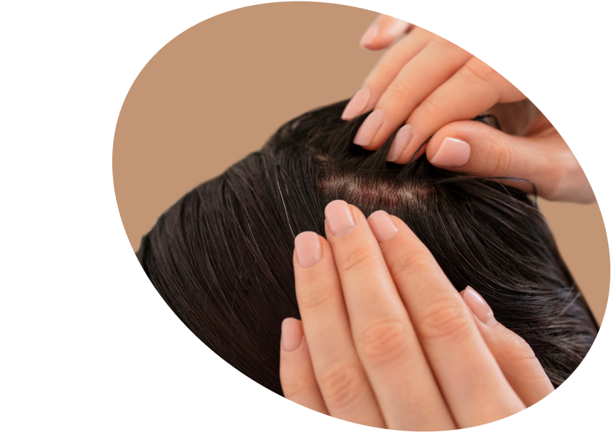 Scalp Psoriasis Solutions Shop - Relief for Scalp Psoriasis Oman