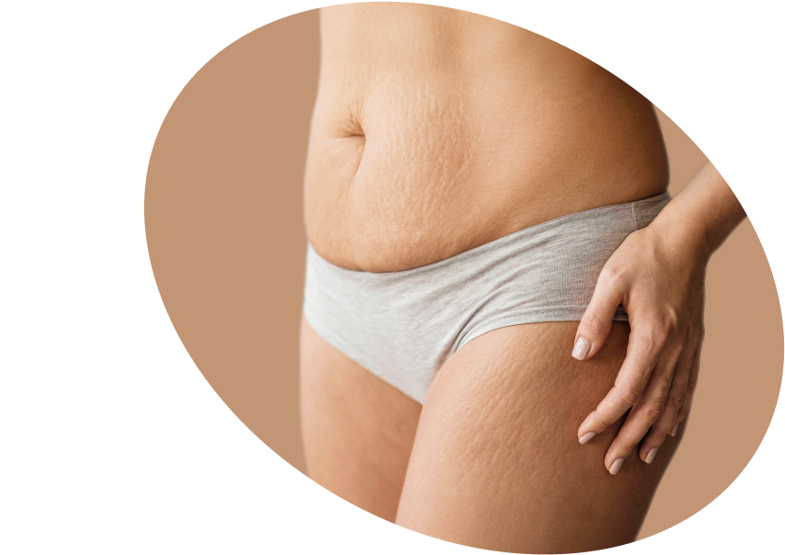 Striae  Care  Shop:  Aanpak  en Voorkom  Striae  Nederland