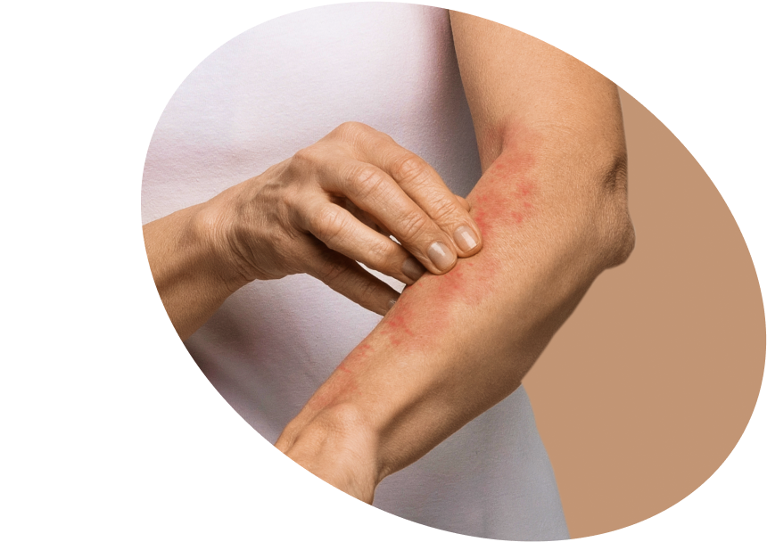 Eczema on the Body - Shop Soothing Skincare Products Luxembourg