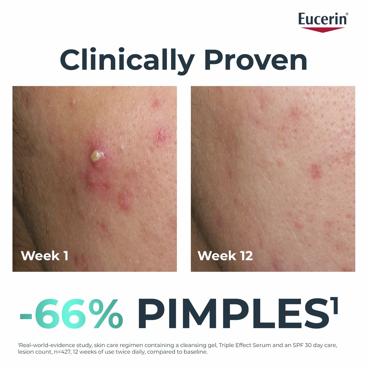 Eucerin DERMOPURE Oil Control Sérum Triple Efecto Piel Propensa al Acné 40ml