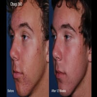 Obagi CLENZIderm M.D.® Daglig Lett Skummende Rens Mot Urenheter 118ml