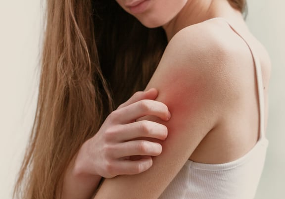 What Is the Best Cream to Stop Itching Skin?