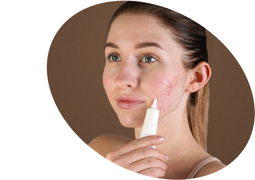 Loja  de Tratamentos  Para  Acne  Brasil